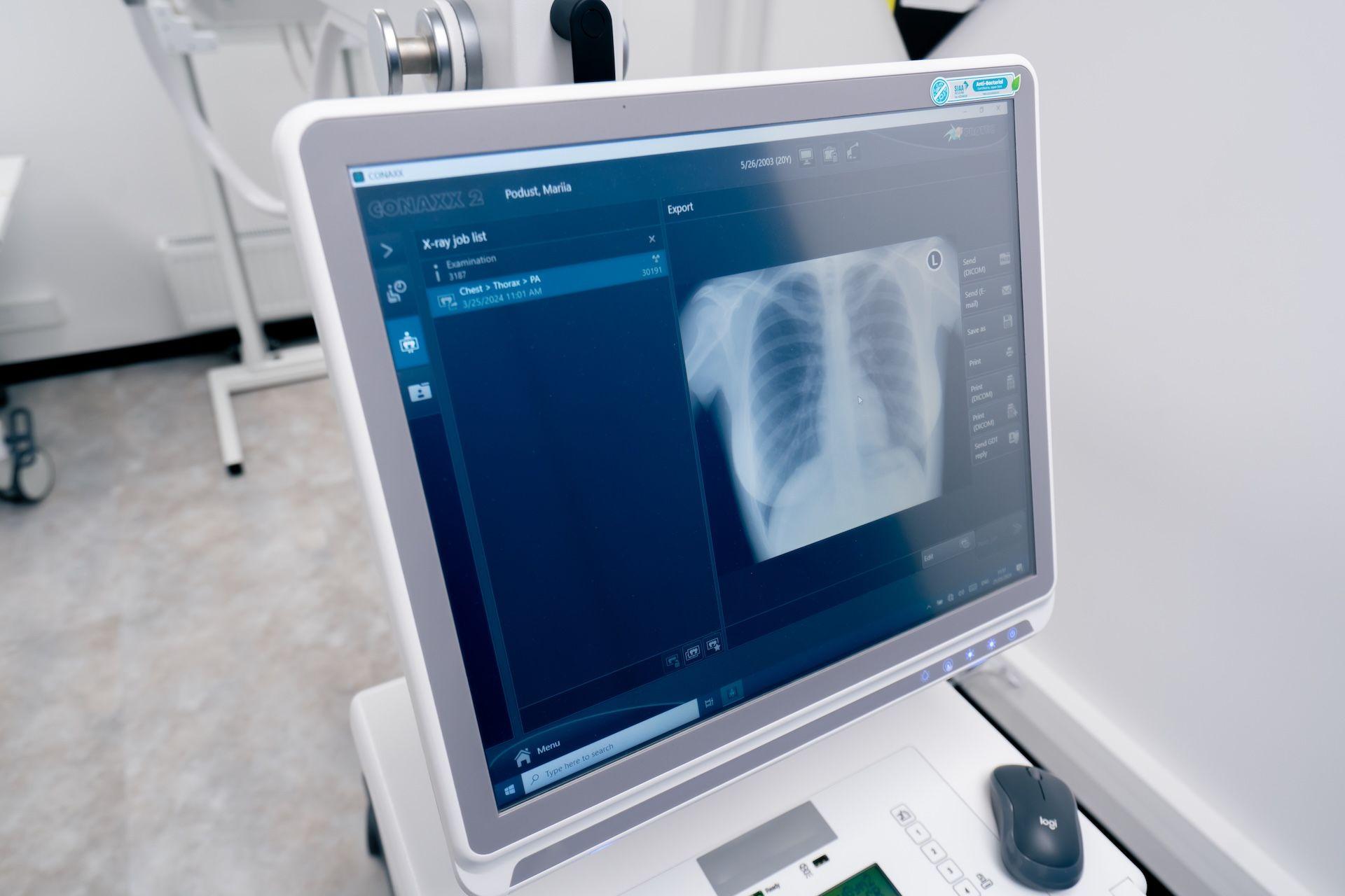 рентген апарат зі знімком легень